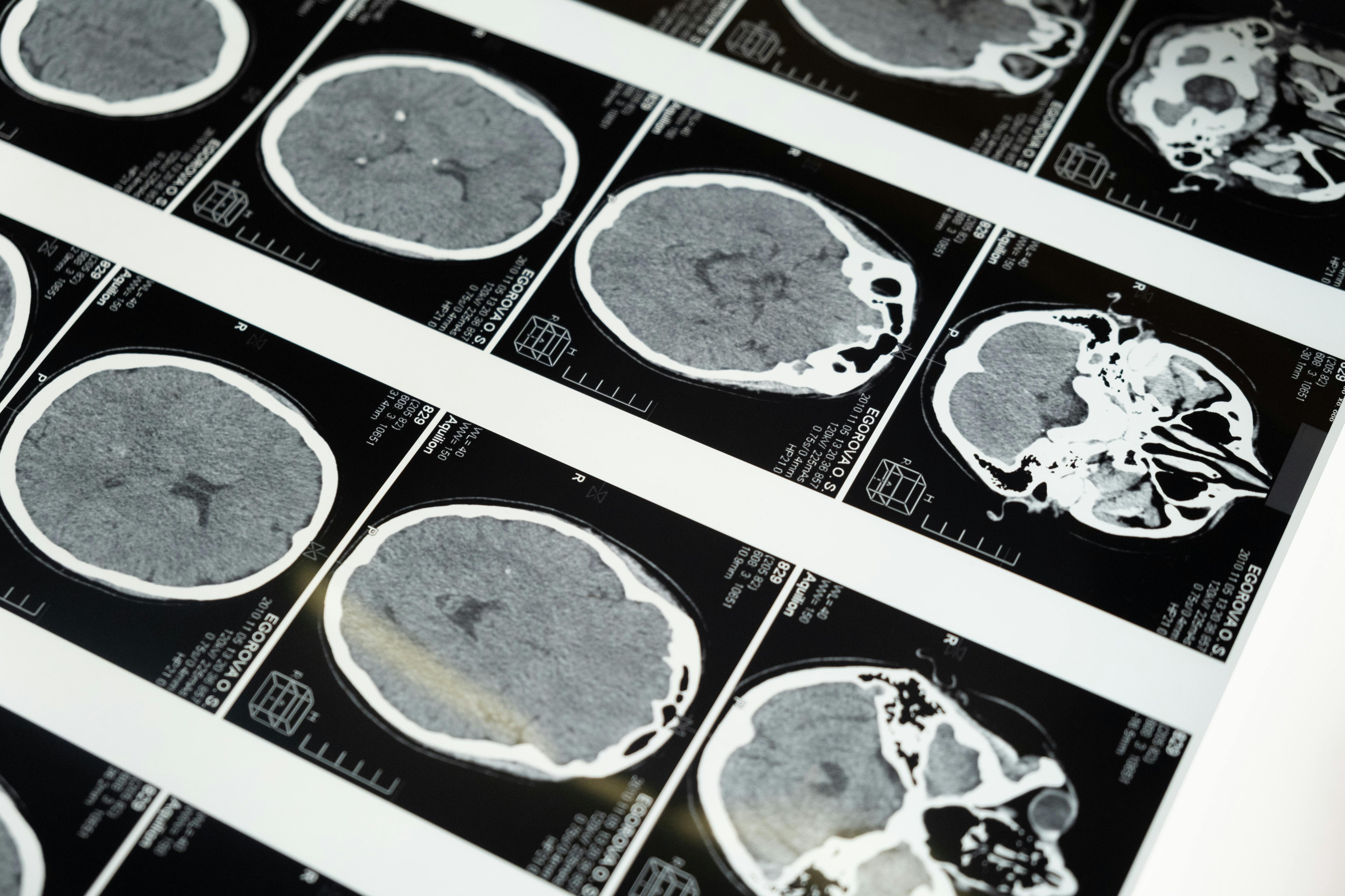 USMLE Step 1: Neurology Tips and Tricks